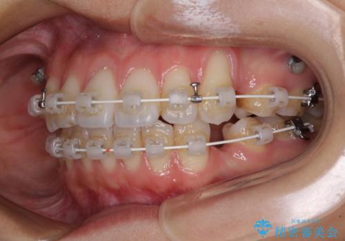【モニター】気になる八重歯を素早く改善 ワイヤー装置での抜歯矯正の治療中