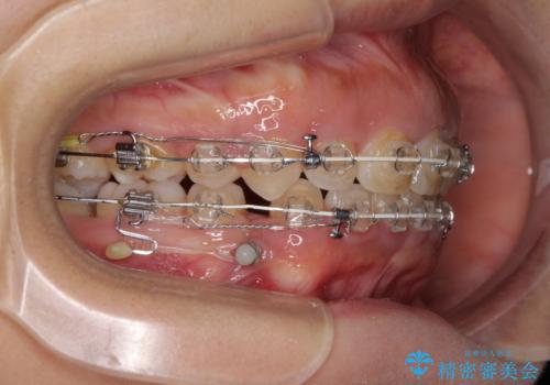 口がしっかりと閉じられない　ワイヤー装置での抜歯矯正で出っ歯を改善の治療中