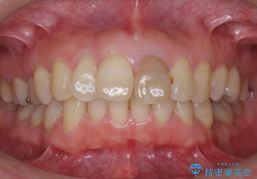 変色した前歯をセラミックでひっこめたい の治療前