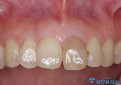 変色した前歯をセラミックでひっこめたい