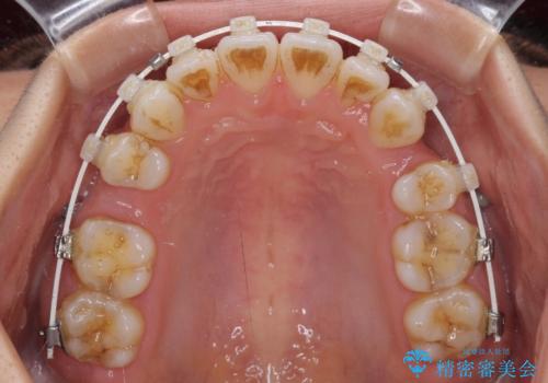 【モニター】気になる八重歯を素早く改善　ワイヤー装置での抜歯矯正の治療中