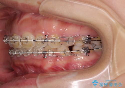 口がしっかりと閉じられない ワイヤー装置での抜歯矯正で出っ歯を改善の治療中