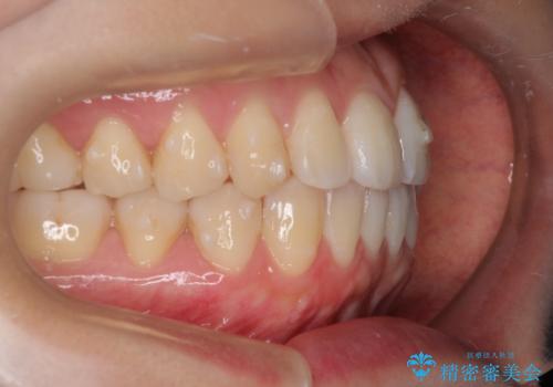 インビザラインによる再矯正症例の治療中