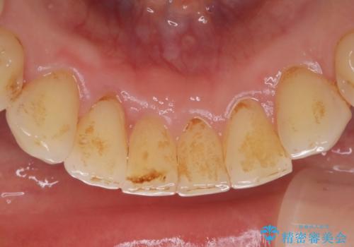 ステイン除去で歯を白くの治療前