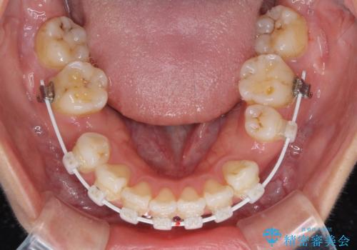 【モニター】気になる八重歯を素早く改善 ワイヤー装置での抜歯矯正の治療中
