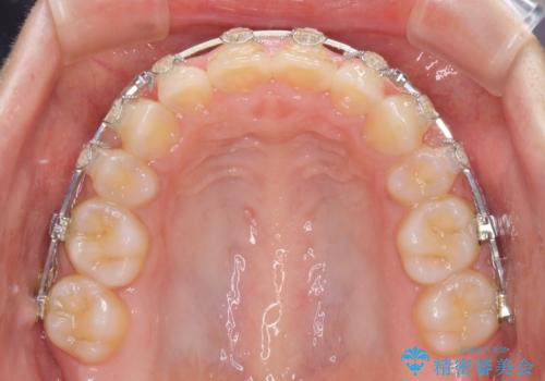 口がしっかりと閉じられない ワイヤー装置での抜歯矯正で出っ歯を改善の治療中