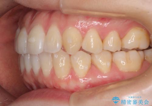 インビザラインによる再矯正症例の治療中