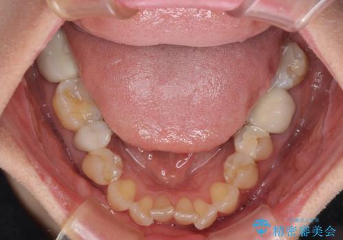 インビザラインは面倒くさい 目立たないワイヤー装置による矯正治療の治療前
