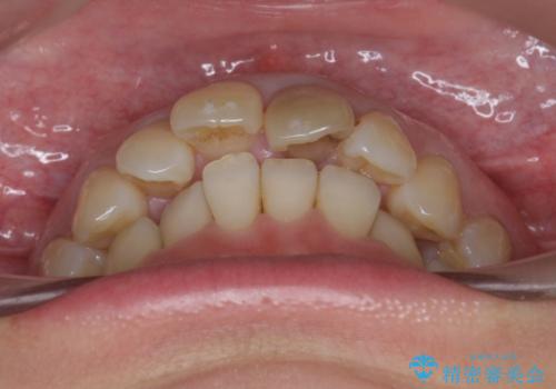 変色した前歯をセラミックでひっこめたい の治療前