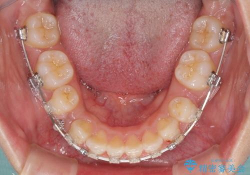 口がしっかりと閉じられない ワイヤー装置での抜歯矯正で出っ歯を改善の治療中