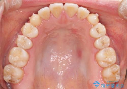 インビザラインによる再矯正症例の治療中