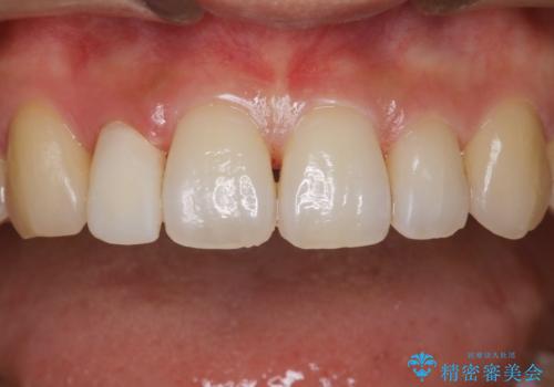ステイン除去で歯を白くの治療後