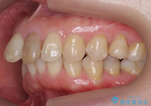 変色した前歯をセラミックでひっこめたい の治療前