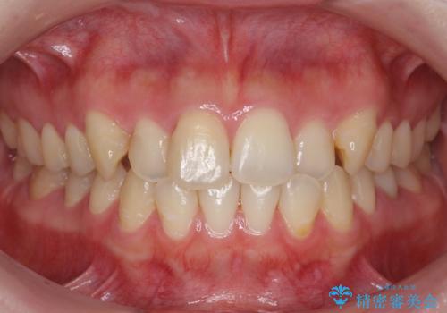 犬歯のねじれ　上の歯が引っ込んでいるの症例 治療前