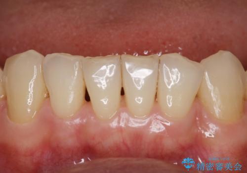 ステイン除去で歯を白くの治療後