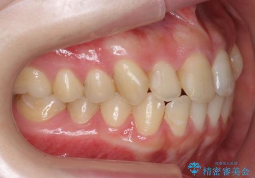 犬歯のねじれ　上の歯が引っ込んでいるの治療前
