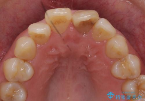 変色した前歯をセラミックでひっこめたい の治療前