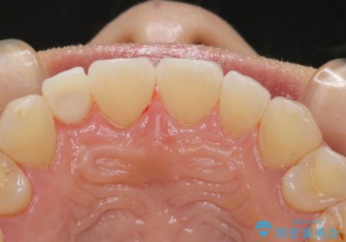 ステイン除去で歯を白くの治療後