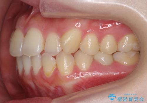 犬歯のねじれ 上の歯が引っ込んでいるの治療前