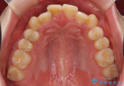 犬歯のねじれ 上の歯が引っ込んでいるの治療前