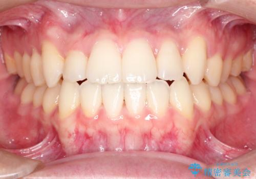 前歯のデコボコ　インビザラインによる目立たない矯正の症例 治療後
