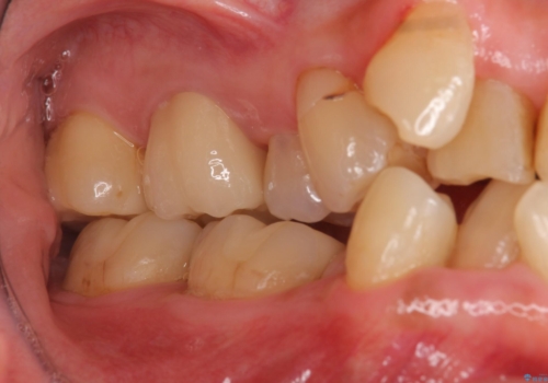 奥歯の銀歯、プラスチックのやりかえの治療後