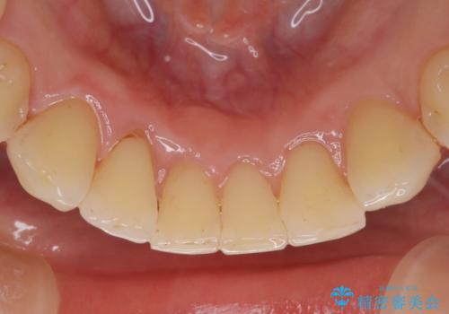 ステイン除去で歯を白くの治療後