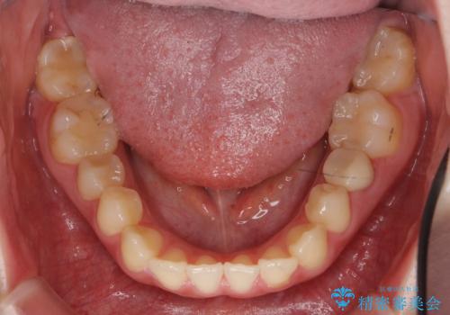 犬歯のねじれ　上の歯が引っ込んでいるの治療前