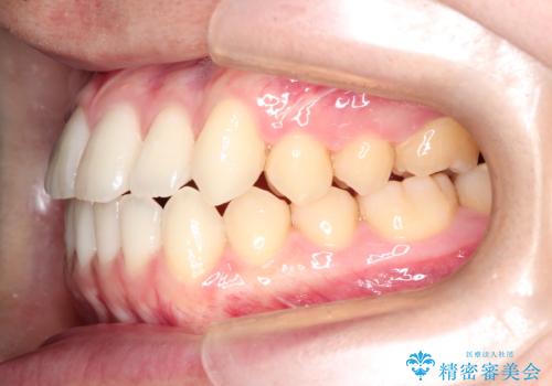 前歯のデコボコ　インビザラインによる目立たない矯正の治療後