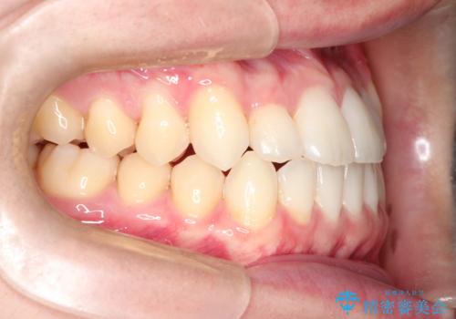 前歯のデコボコ　インビザラインによる目立たない矯正の治療後