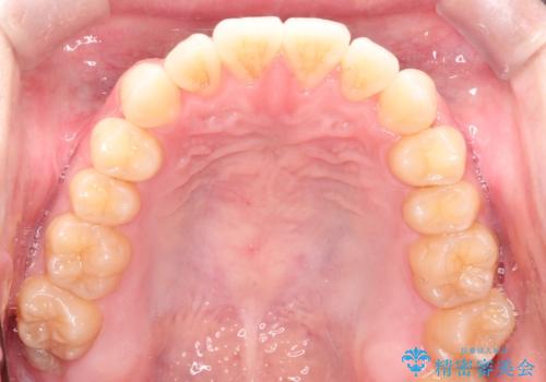 前歯のデコボコ インビザラインによる目立たない矯正の治療後