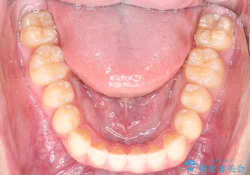 前歯のデコボコ インビザラインによる目立たない矯正の治療後