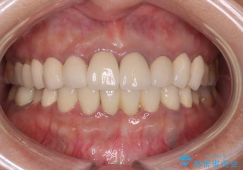 前歯が一本取れた オールセラミックブリッジによる補綴治療の治療後