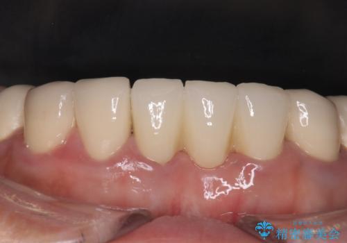 前歯が一本取れた オールセラミックブリッジによる補綴治療の治療後