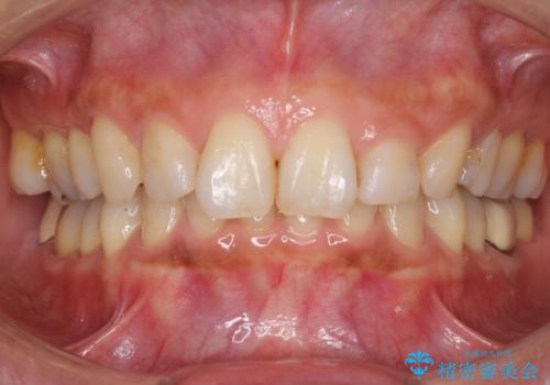 抜歯矯正の後戻りでできたスペース インビザライン矯正とセラミック治療の症例 治療前