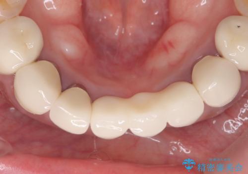 前歯が一本取れた オールセラミックブリッジによる補綴治療の治療後