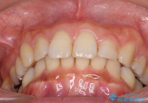 抜歯矯正の後戻りでできたスペース インビザライン矯正とセラミック治療の治療前