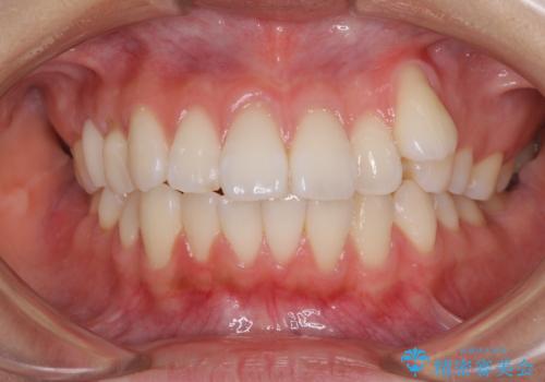 【モニター】気になる八重歯を素早く改善　ワイヤー装置での抜歯矯正の症例 治療前