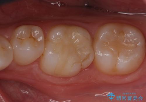以前入れた詰め物が欠けた