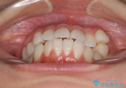 【モニター】気になる八重歯を素早く改善 ワイヤー装置での抜歯矯正の治療前
