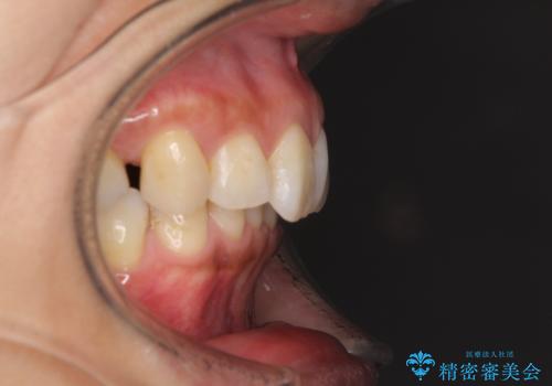 抜歯矯正の後戻りでできたスペース インビザライン矯正とセラミック治療の治療前