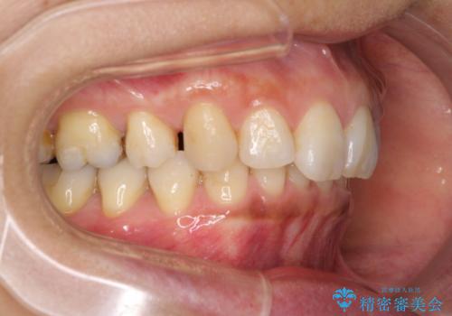 抜歯矯正の後戻りでできたスペース インビザライン矯正とセラミック治療の治療前