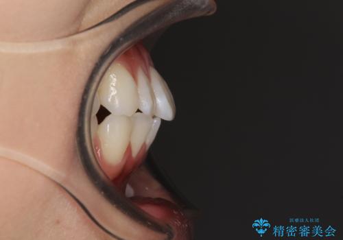 【モニター】気になる八重歯を素早く改善 ワイヤー装置での抜歯矯正の治療前