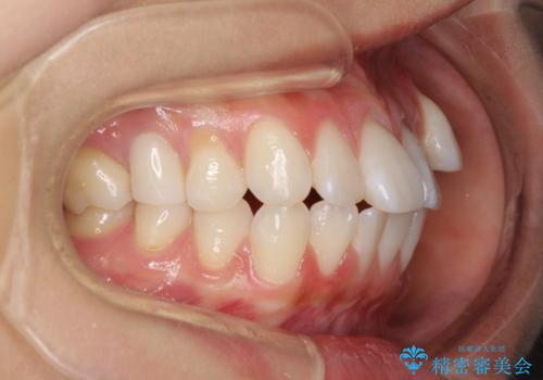 【モニター】気になる八重歯を素早く改善 ワイヤー装置での抜歯矯正の治療前