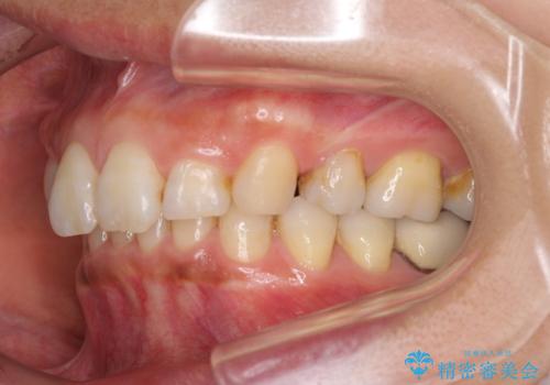 抜歯矯正の後戻りでできたスペース インビザライン矯正とセラミック治療の治療前