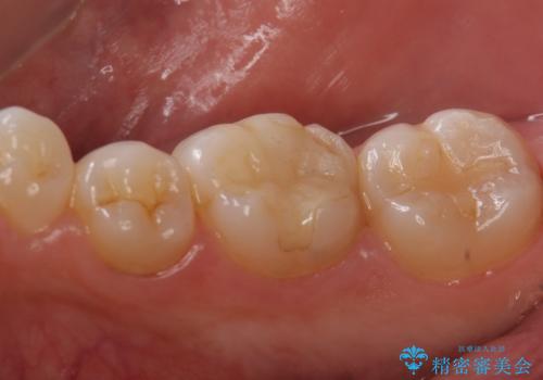 以前入れた詰め物が欠けたの治療前