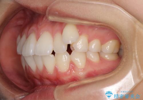 【モニター】気になる八重歯を素早く改善　ワイヤー装置での抜歯矯正の治療前