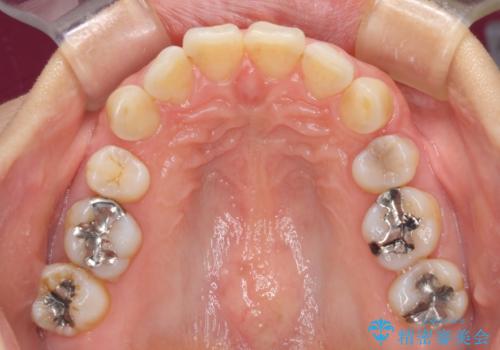 抜歯矯正の後戻りでできたスペース インビザライン矯正とセラミック治療の治療前