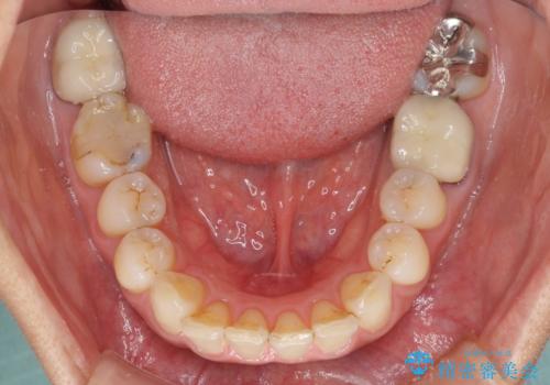 抜歯矯正の後戻りでできたスペース インビザライン矯正とセラミック治療の治療前