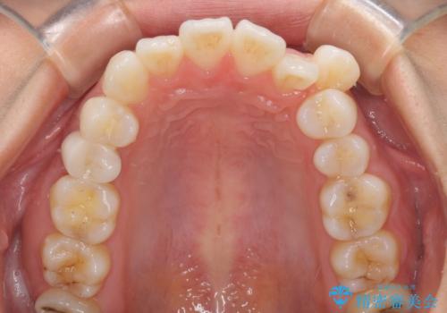 【モニター】気になる八重歯を素早く改善 ワイヤー装置での抜歯矯正の治療前